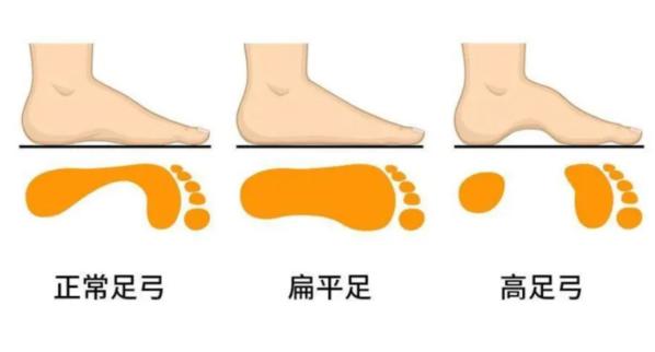 “扁平足”是疾病嗎？是否需要醫(yī)學(xué)干預(yù)？