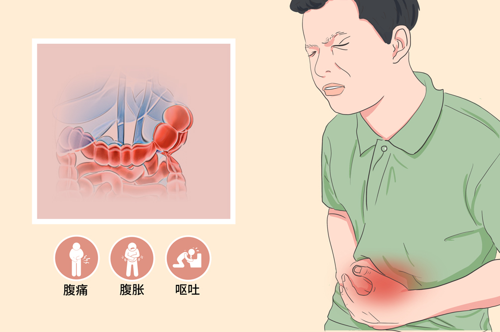 贊！不用開刀，一根導(dǎo)管打通腸梗阻！