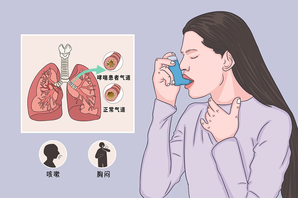 第25個(gè)世界哮喘日：如何防治，一起了解！