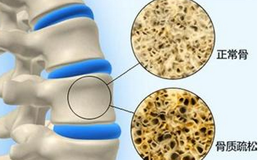 骨質(zhì)疏松，不僅補(bǔ)鈣這么簡(jiǎn)單！