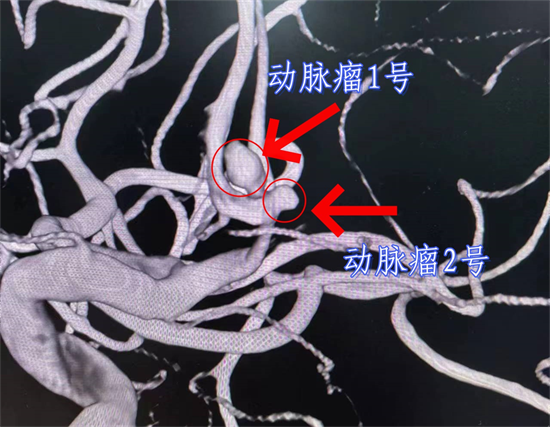 一“介”雙雕 顱內(nèi)動脈瘤治療又有新突破